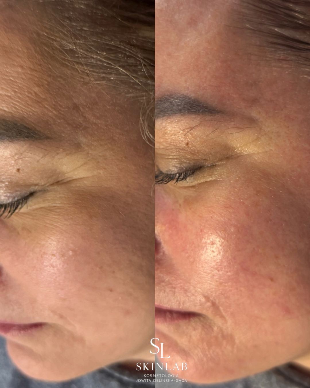 Efekt zabiegu kosmetologicznego - SkinLab Bydgoszcz